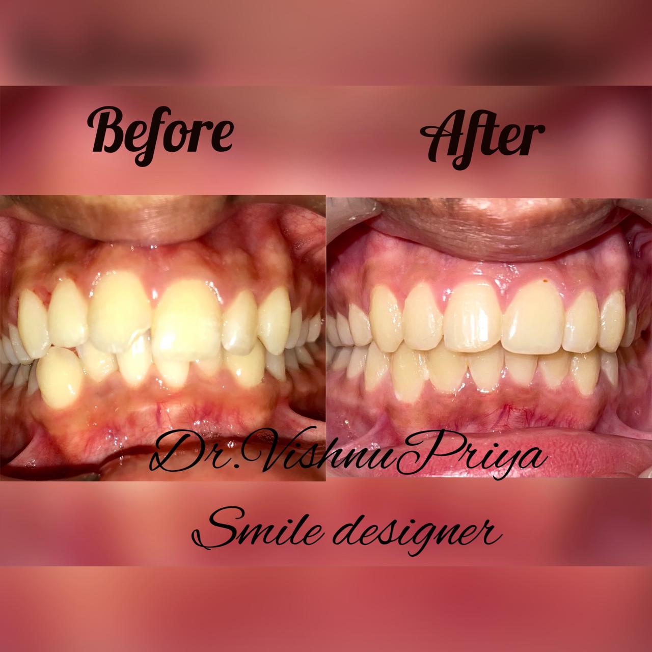 dental-braces-patient