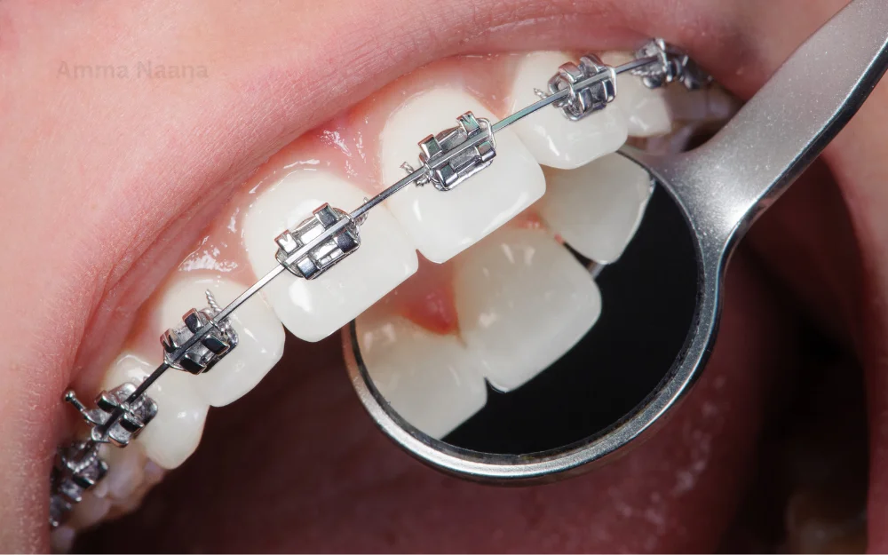 Dental Braces at Amma Naana Dental Clinic