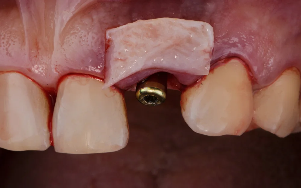 Bone Grafting at Amma Naana Dental Clinic