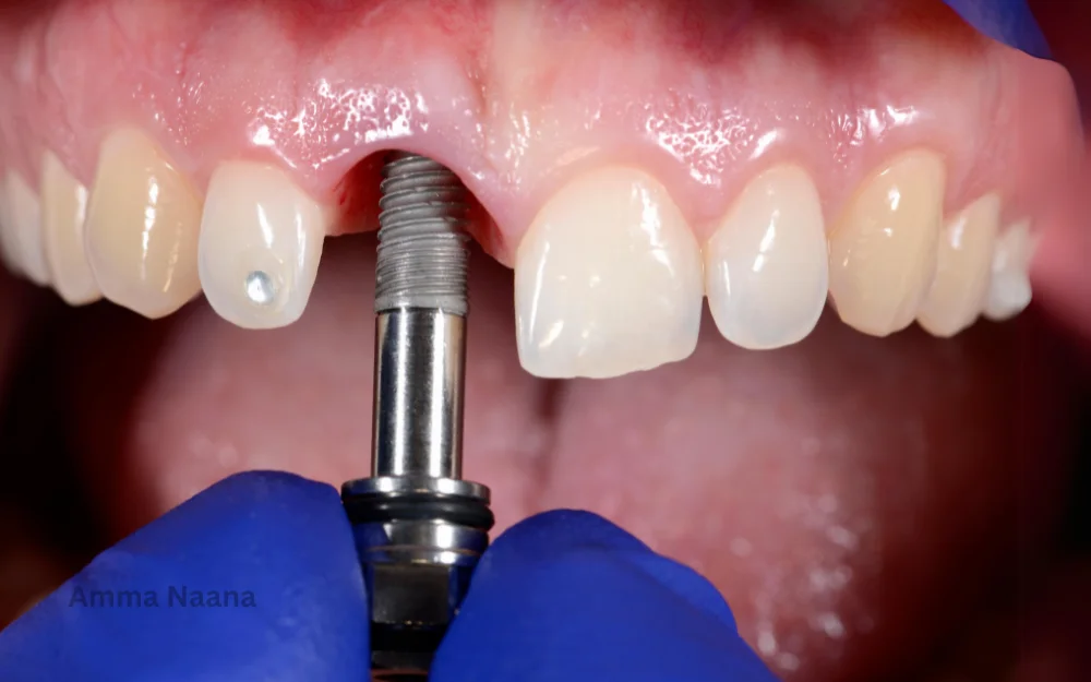 Dental Implant