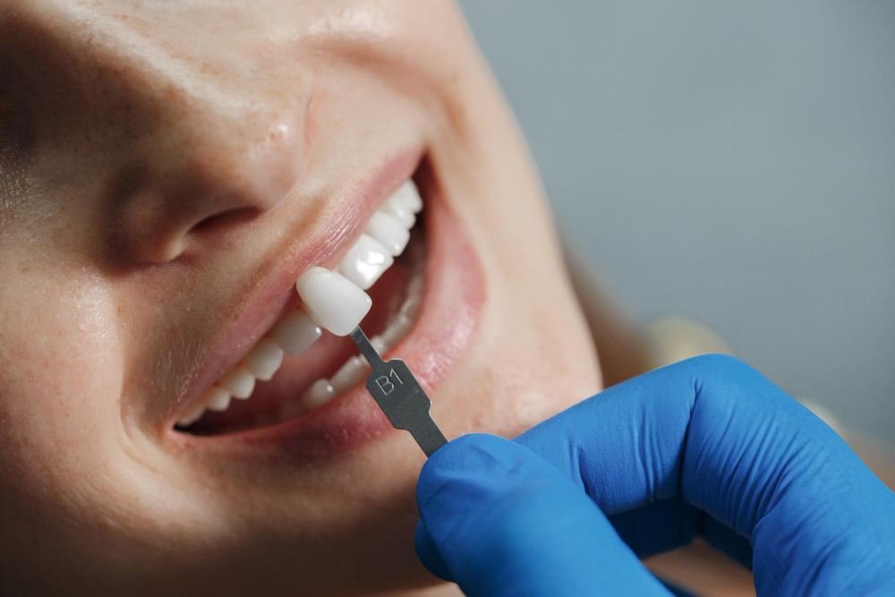 Permanent Dental Implants Chennai