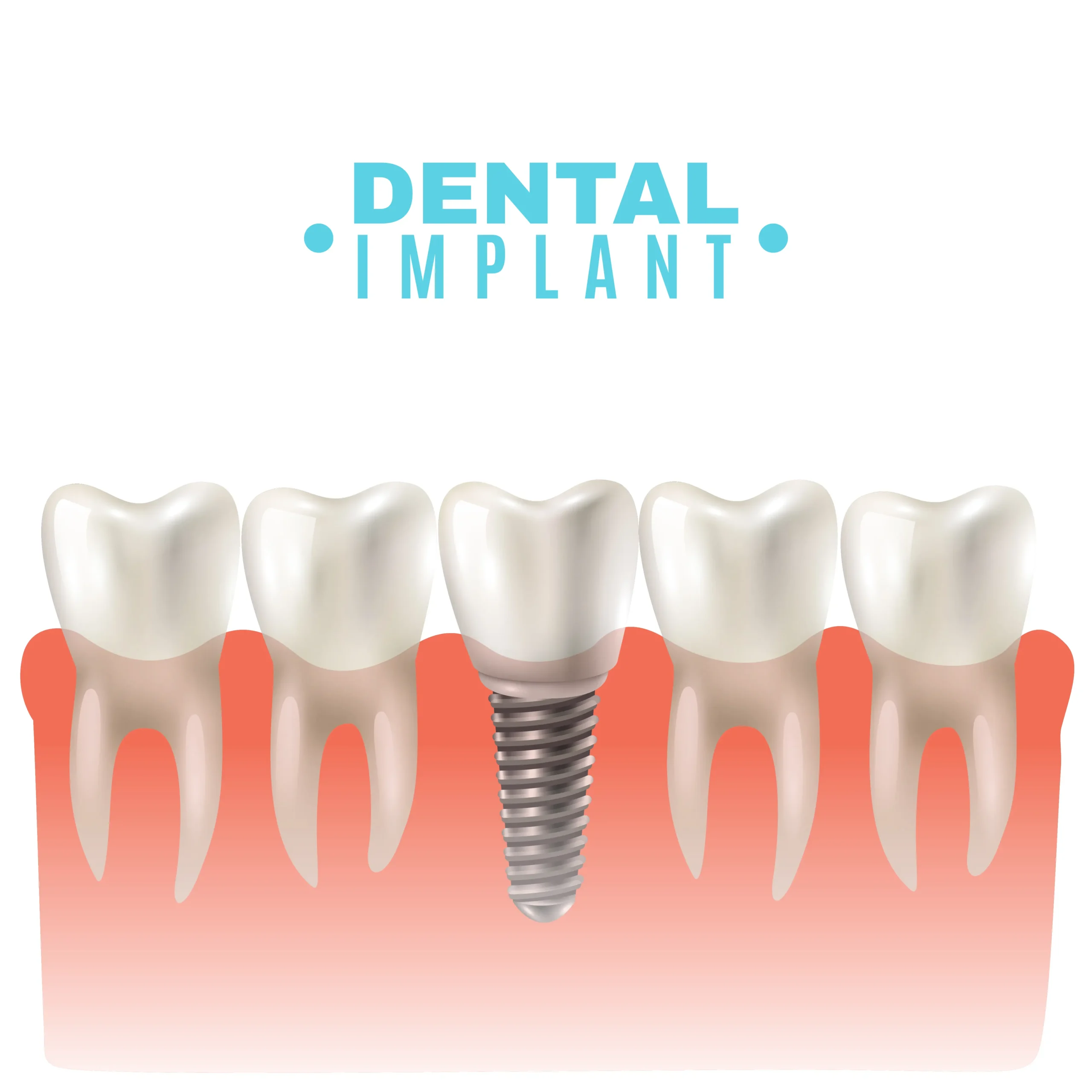 Advanced 3D Dental Implant Technology