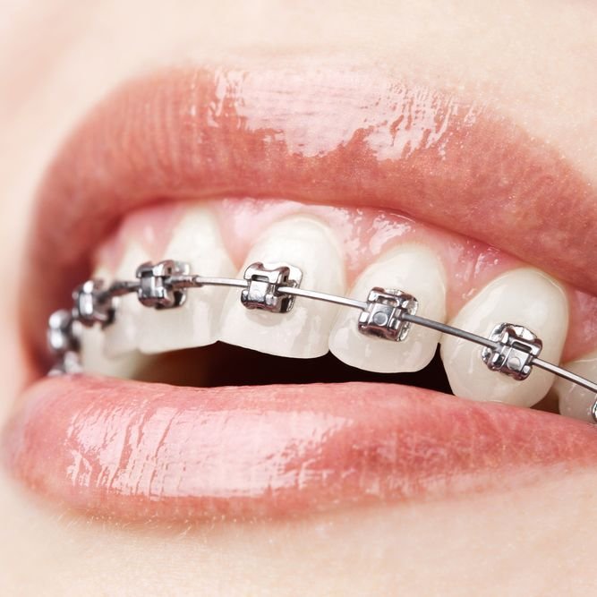 Orthodontic Braces Chennai