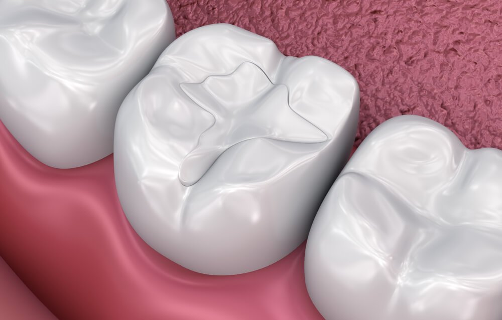 Cosmetic Fillings Dentist
