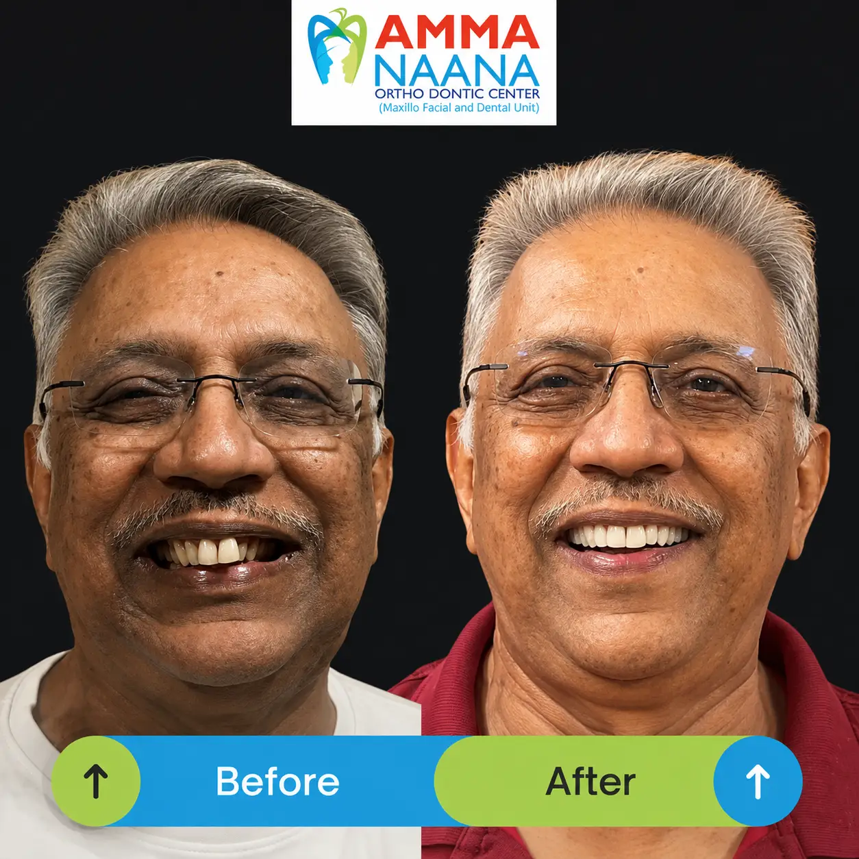 Before and After Invisalign Senior Citizen