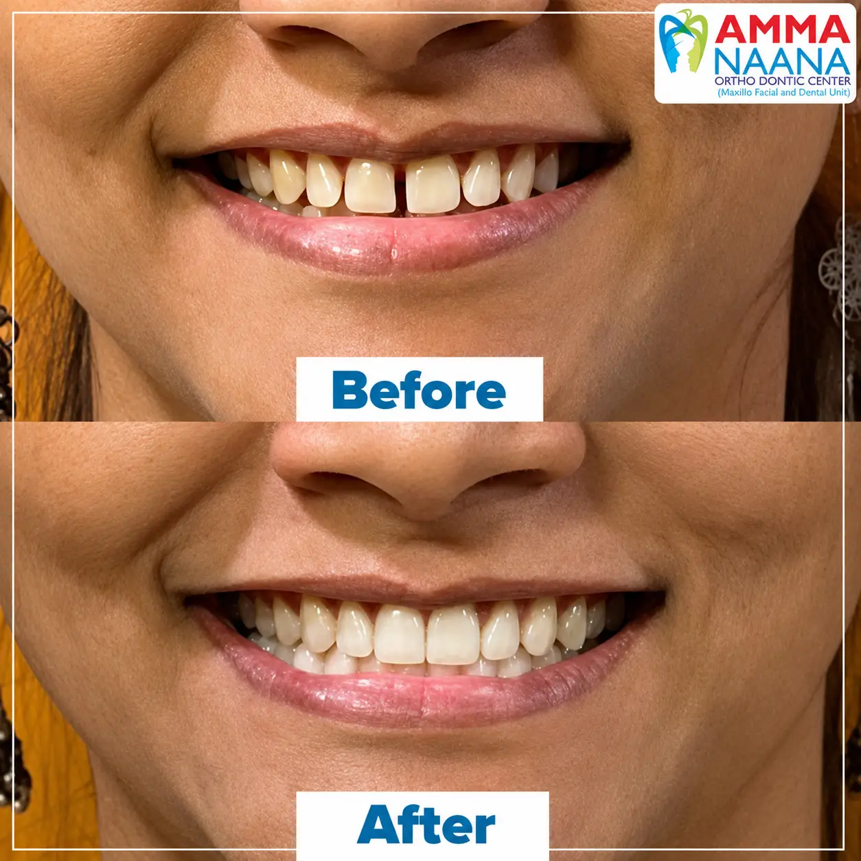 Before and After Invisalign Adult Women