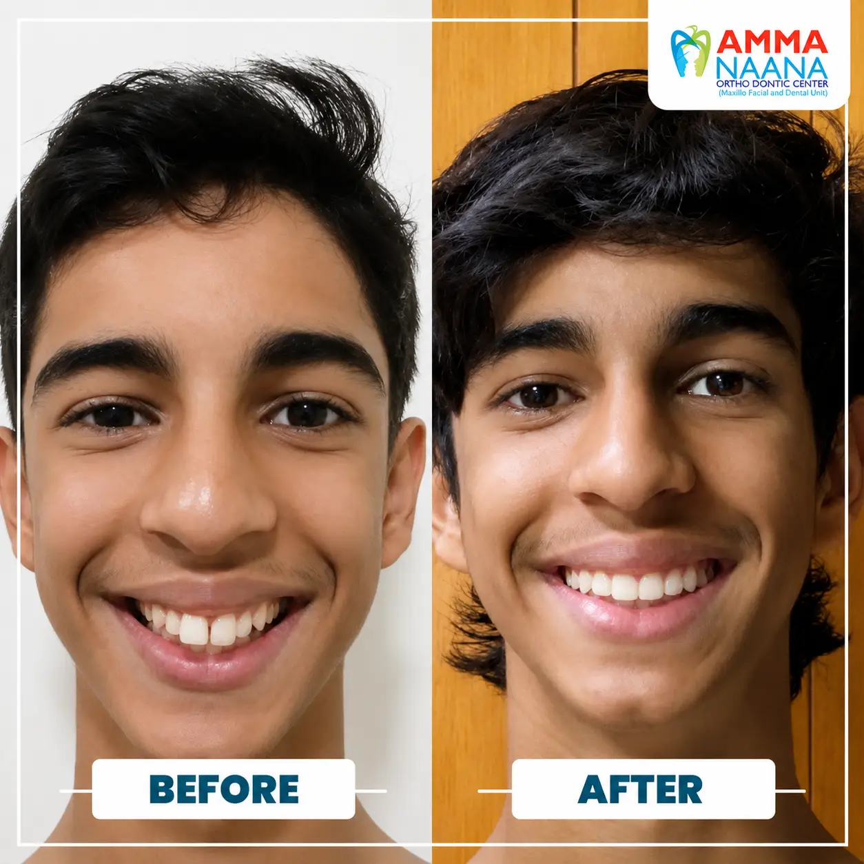 Before and After Invisalign Teen Male