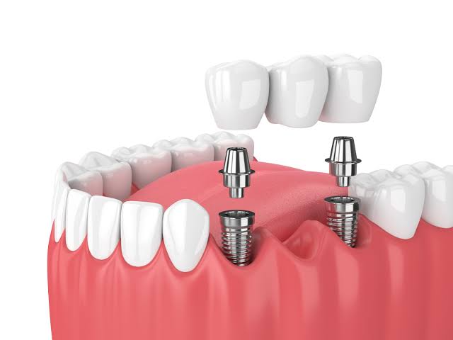Dental Implants Chennai
