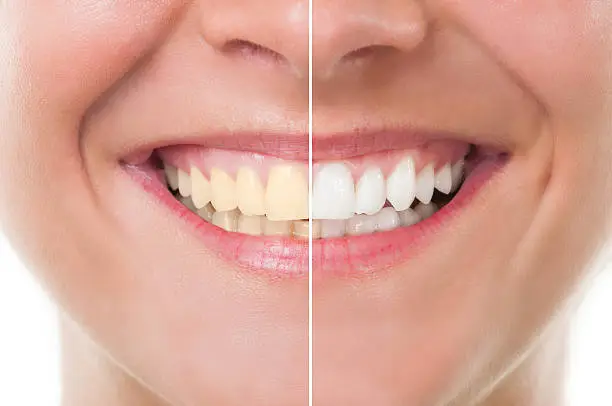 In-Clinic Laser Teeth Whitening