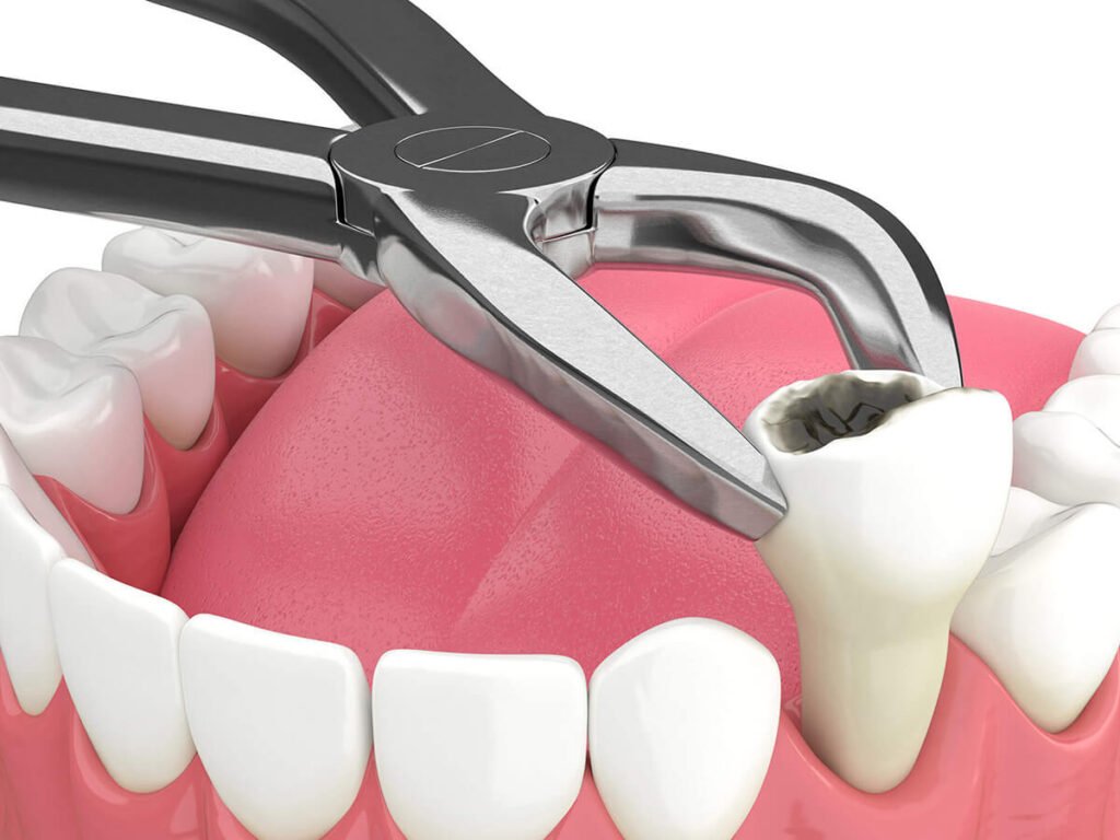 Safe Tooth Extraction Kilpauk